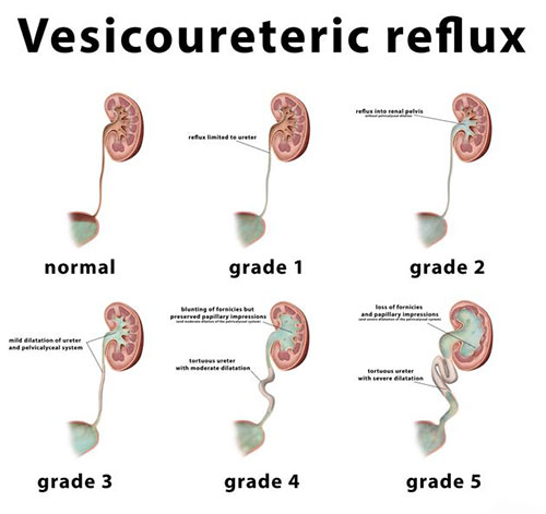 Vesico-ureteric Reflux